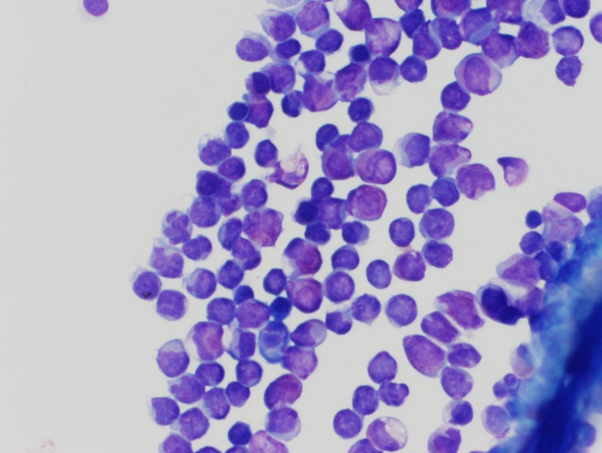 Cytospin of bone marrow aspirate showing immature cells with intermediate to large size, irregular nuclear contours with some folded nuclei, prominent nucleoli, and granular cytoplasm, including Auer rods.